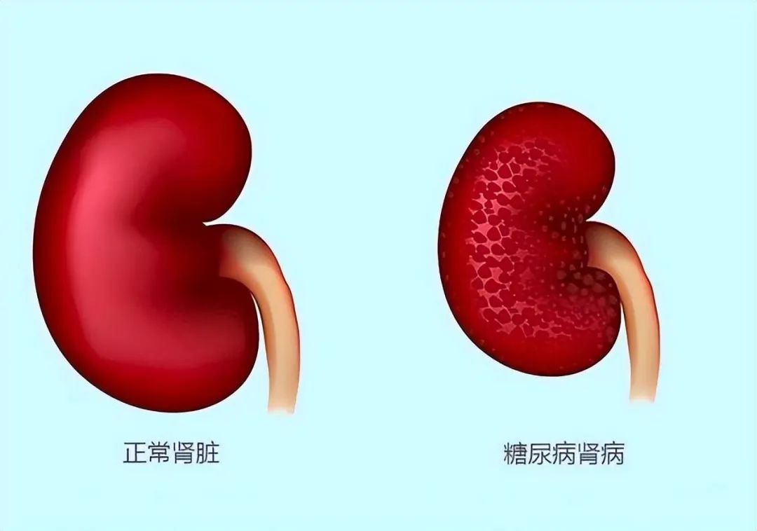 什么是糖尿病腎??？